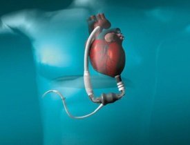 Искусственное сердце, пересадка искусственного сердца, аппарат искусственное сер